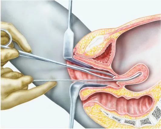 Пункция через задний свод. Аспирационная пайпель биопсия. Что такое пайпель биопсия в гинекологии. Аспирационная биопсия выскабливание.